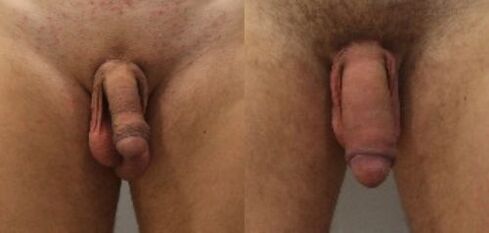 before and after penis enlargement surgery
