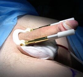 How is penis enlargement surgery performed